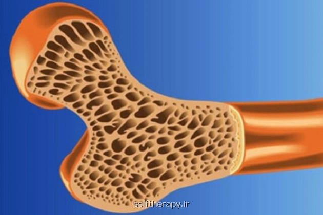 اهمیت کاهش مصرف نمک برای سلامت استخوان ها